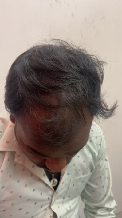 After treatment