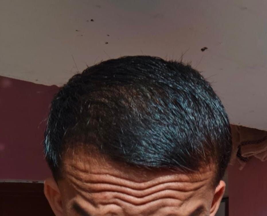 Before treatment