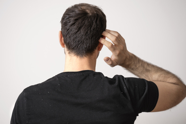 Dandruff Treatment